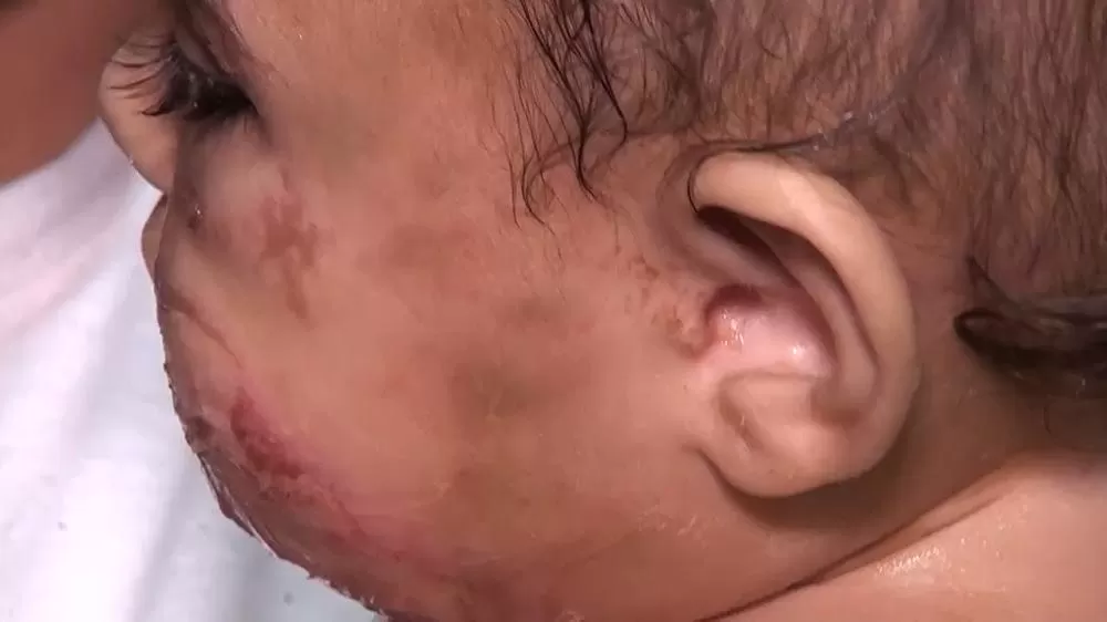 Bebê de 11 Meses Aparece com Queimaduras Graves no Rosto e Polícia Civil Investiga Agressão em Ji-Paraná