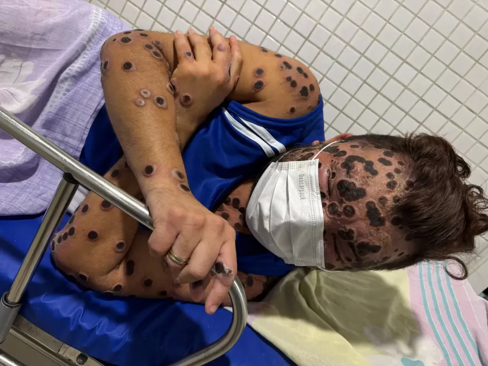 Mpox explode no Amazonas Após Confirmação de 35 Casos de Varíola do Macaco 