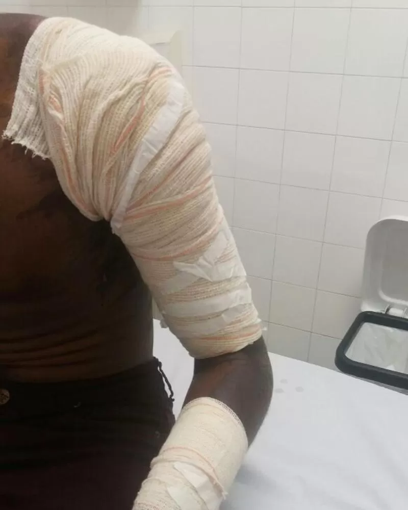 Ji-Paraná: Mulher ataca Marido com Facada e acaba Queimada com Óleo Fervendo na Linha 94 Travessão N