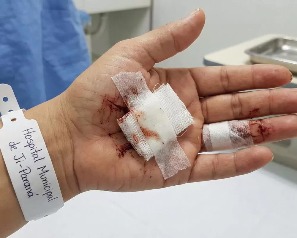 Mulher acaba esfaqueada pela companheira e atendida no Hospital Municipal de Ji-Paraná após desentendimento 