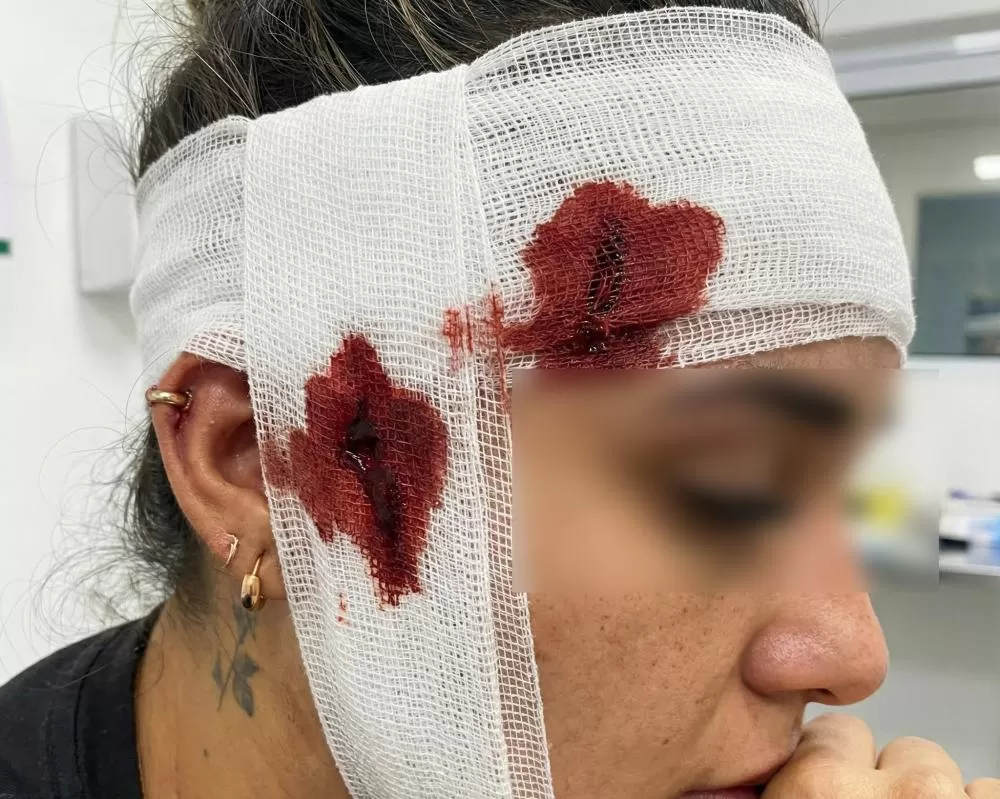 Jovem sofre corte profundo e intenso sangramento no rosto após o irmão quebrar copo de vidro durante discussão em Ji-Paraná