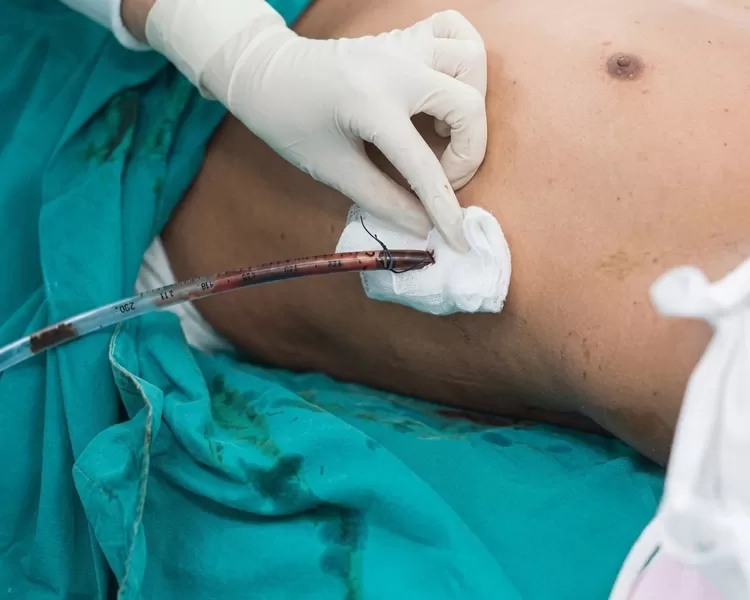 Paciente internado após espancamento deixa Hospital Municipal de Ji-Paraná após retirar dreno torácico