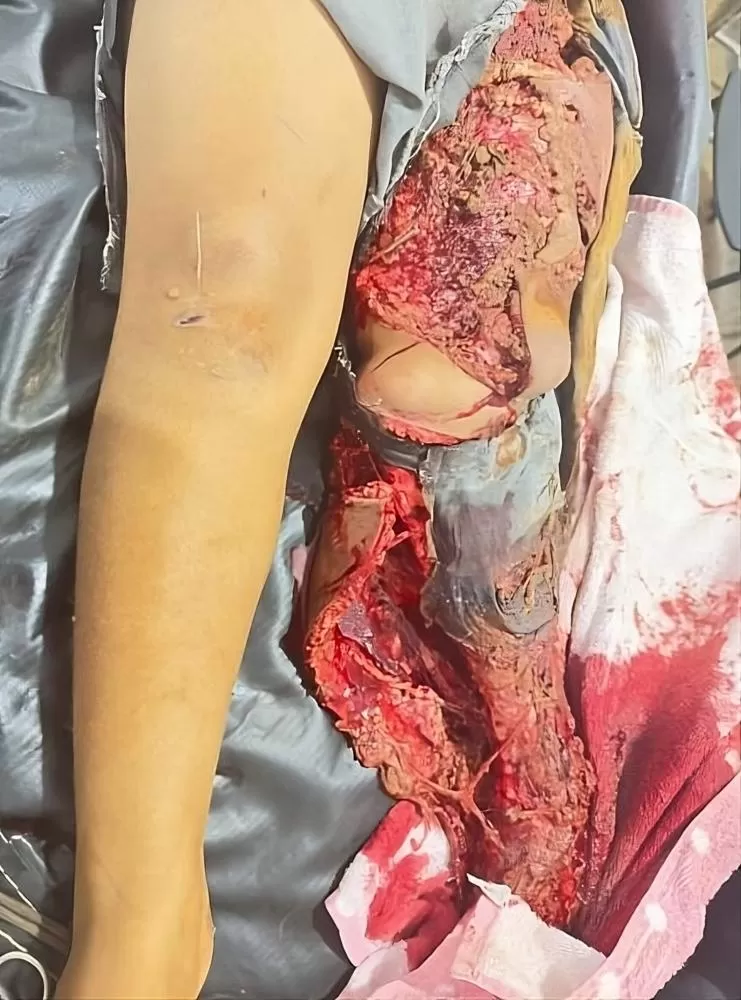 Ji-Paraná: Criança de 9 Anos Sofre Acidente Grave com Ônibus Escolar em Zona Rural